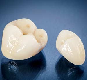 Dental Crowns