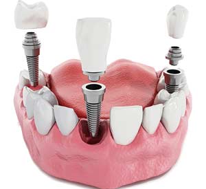 Dental Implants