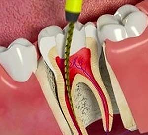 Root Canal Therapy